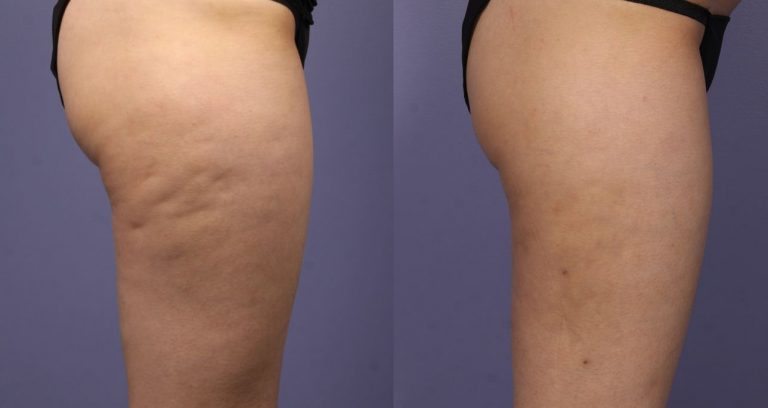 eliminare cellulite 10 giorni
